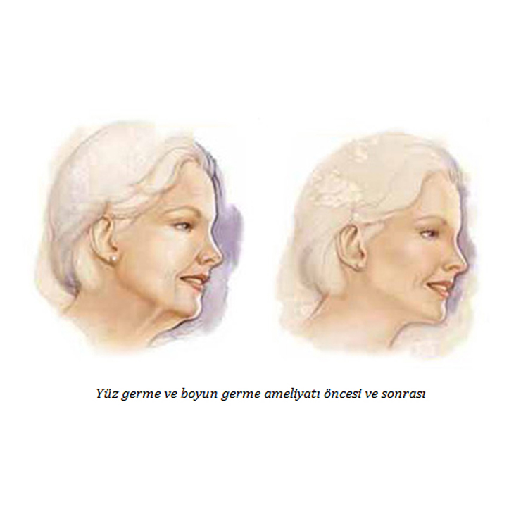 Yüz Boyun Germe