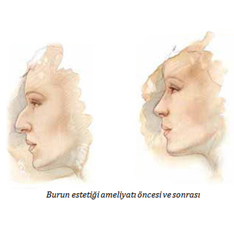 Burun Estetiği